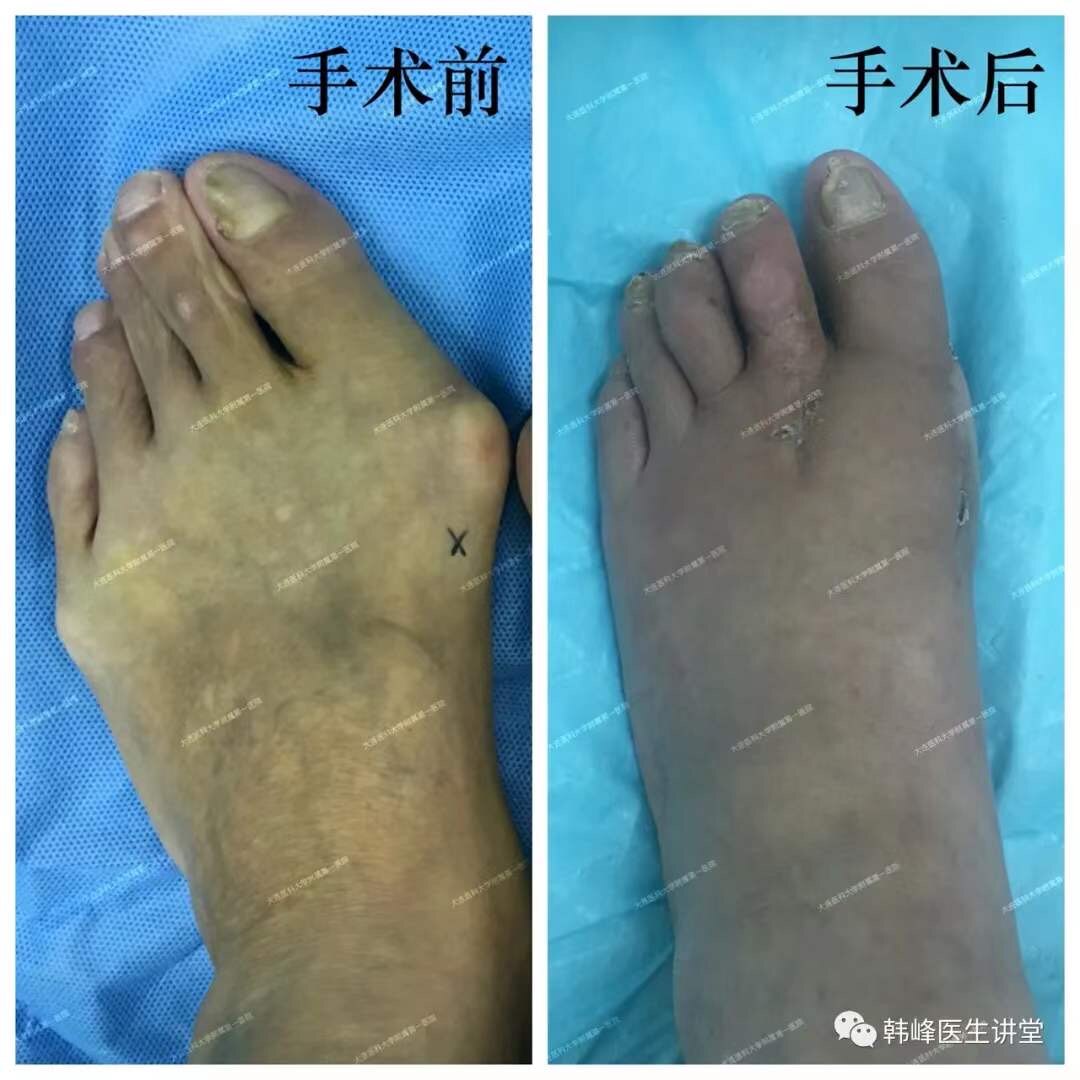 足部问题科普系列第一部分拇囊炎