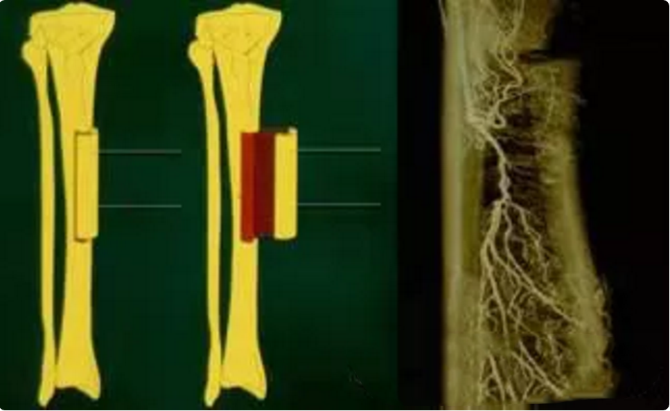 胫骨横向骨搬运技术,可以打破足溃疡截肢魔咒?