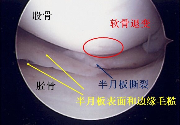 如何拯救退变性半月板撕裂?-专家的建议