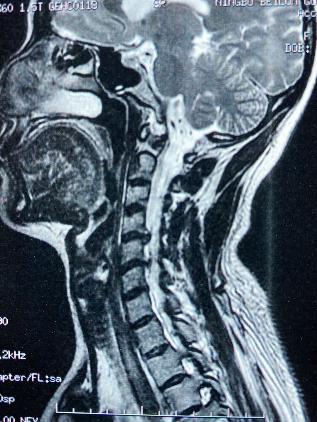 术前磁共振显示两节段巨大椎间盘突出