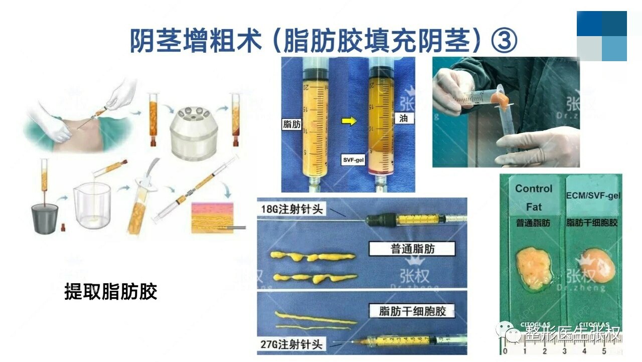 脂肪胶阴茎增粗术图解