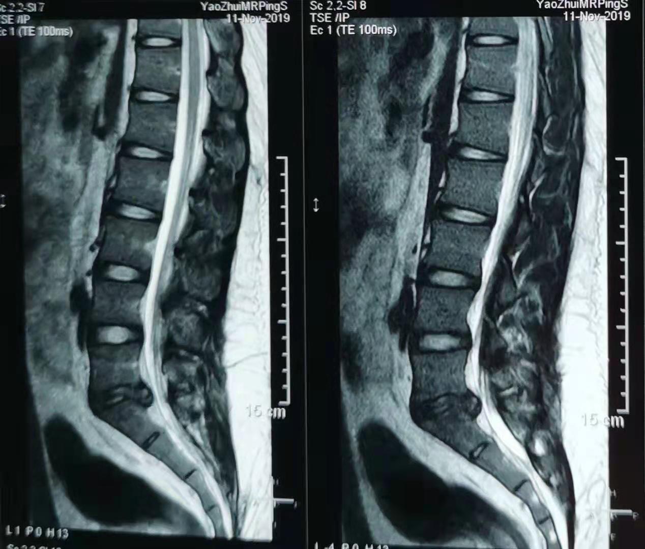 20岁学生得腰椎间盘突出症,疼痛不能行走,怎么治疗?