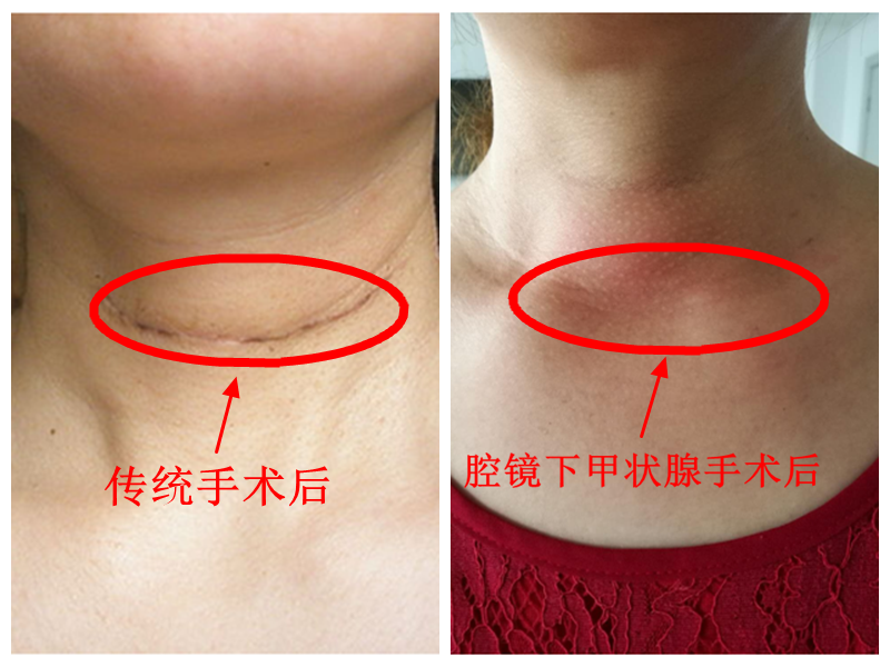 颈部无痕,美丽常驻:关于腔镜甲状腺手术_甲状腺结节