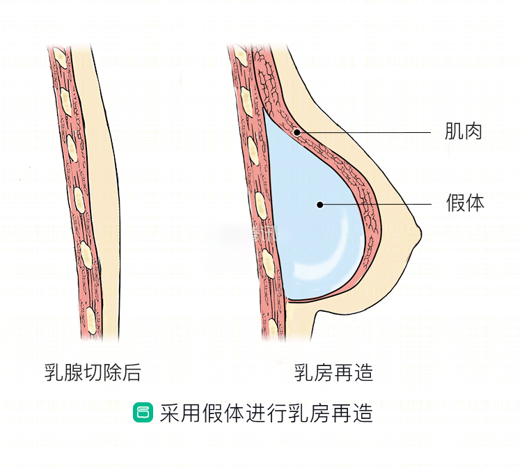 乳房再造,可通过假体丰胸_隆胸_隆胸 - 好大夫在线