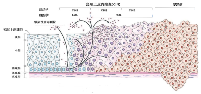 细胞学分类相同的二级分类法,即低级别鳞状上皮内病变(lsil)和高级别