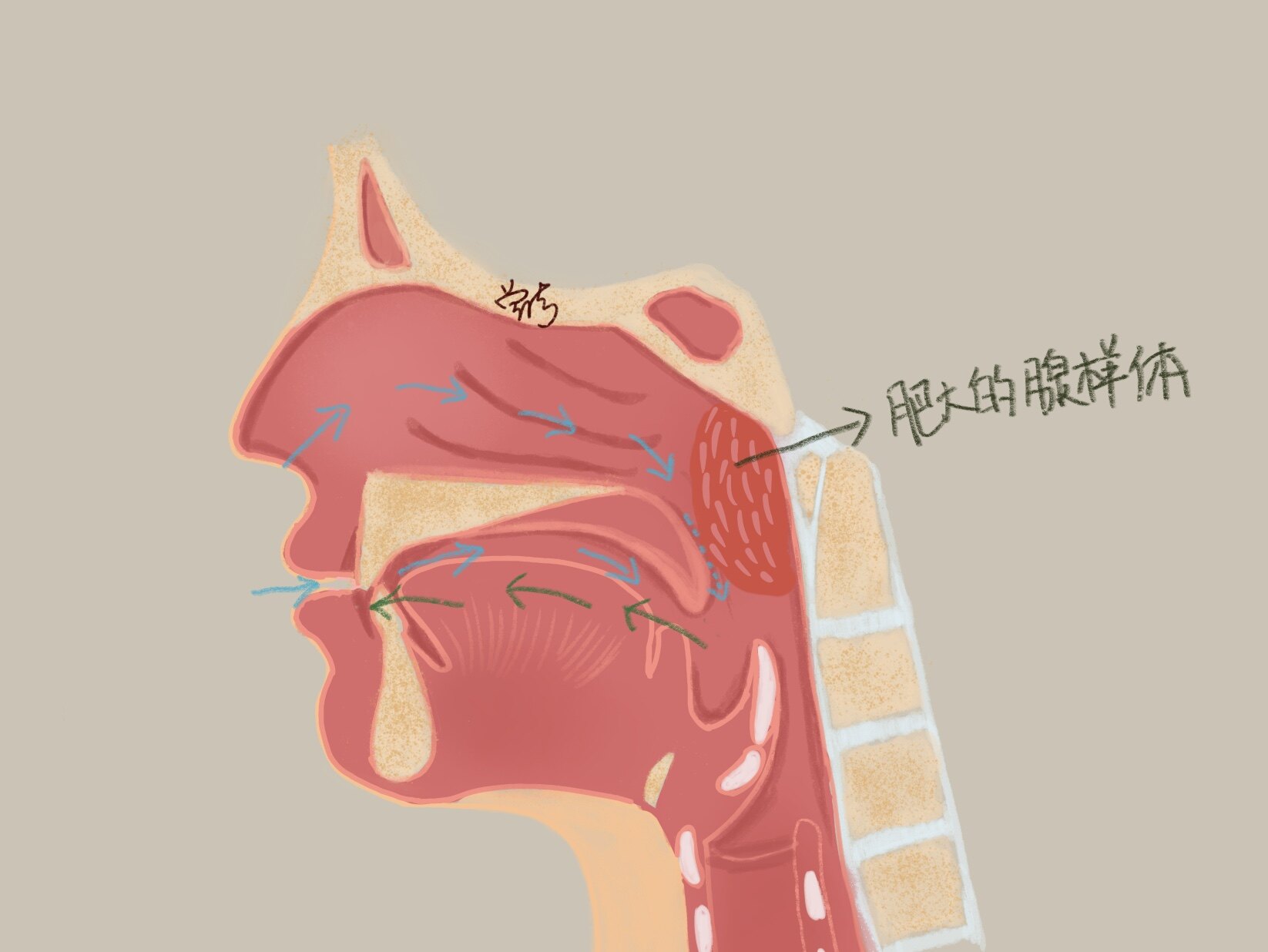 腭骨高拱,牙列不齐,上切牙突出,唇厚,缺乏表情,称为腺样体面容