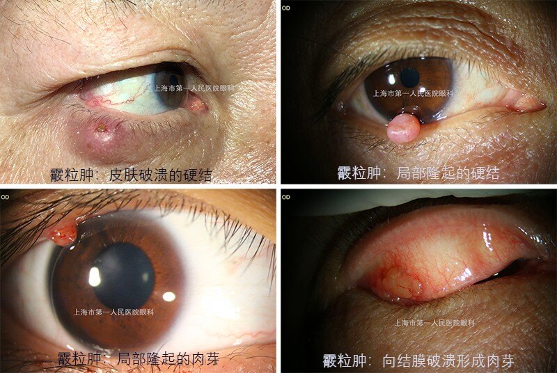 眼皮反复长"霰粒肿",要警惕眼睑恶性肿瘤!