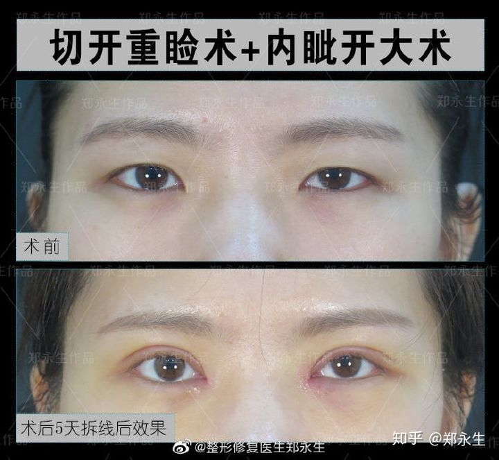 如何让单眼皮变成双眼皮有几种方法