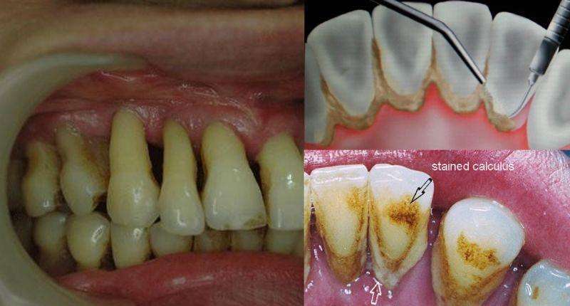 牙周萎缩的程度及表现都因人而异,主要表现为牙槽骨高度降低,牙龈