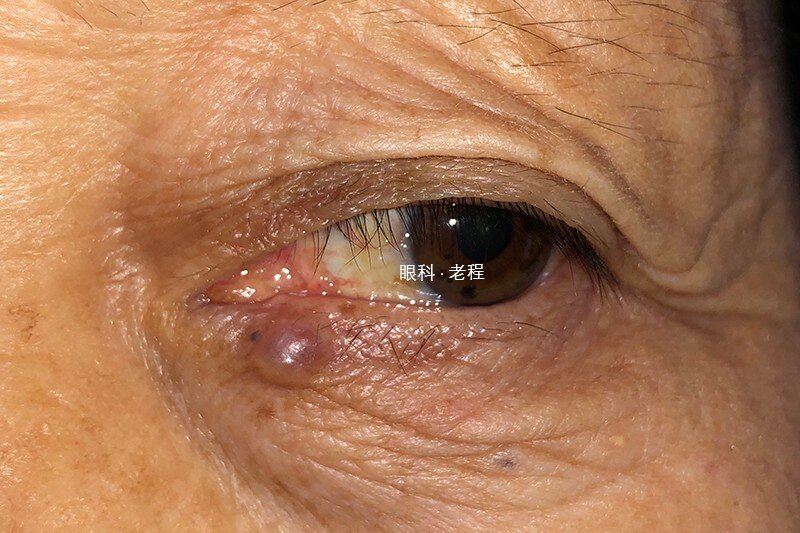 眼皮小小的肉芽,须当心,可能是眼睑癌的早期表现