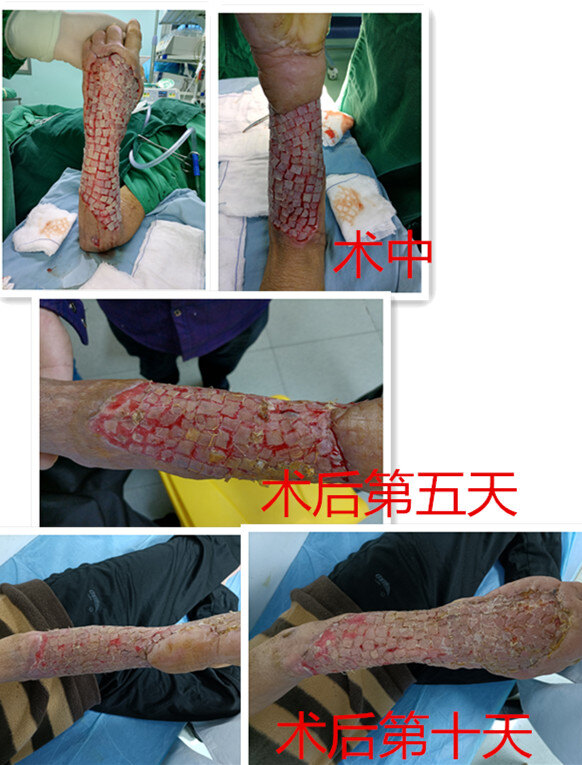 一左上肢坏死性筋膜炎患者从肉芽创面形成到植皮成活过程