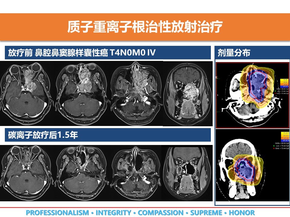 质子重离子放射治疗让头颈部腺样囊性癌不再难治