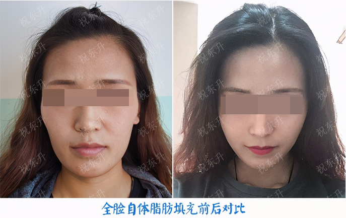 额头,太阳穴,面颊凹陷,自体脂肪填充能改善到什么程度?