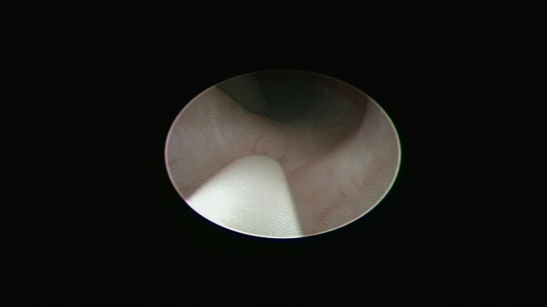 经尿道输尿管软镜钬激光碎石术rirs