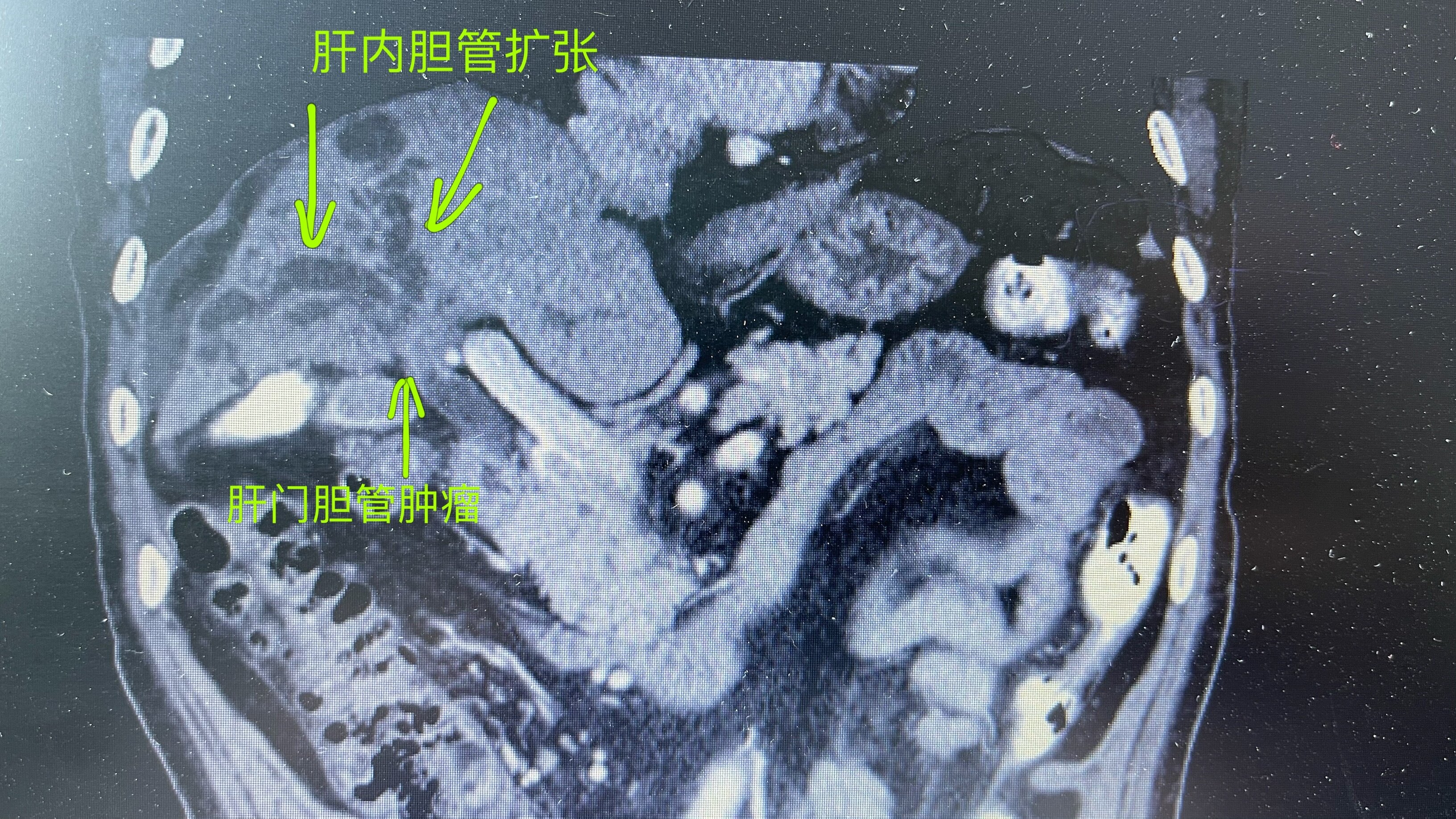 胆管细胞癌早期核磁表现_直男癌直女癌_胆管癌食谱