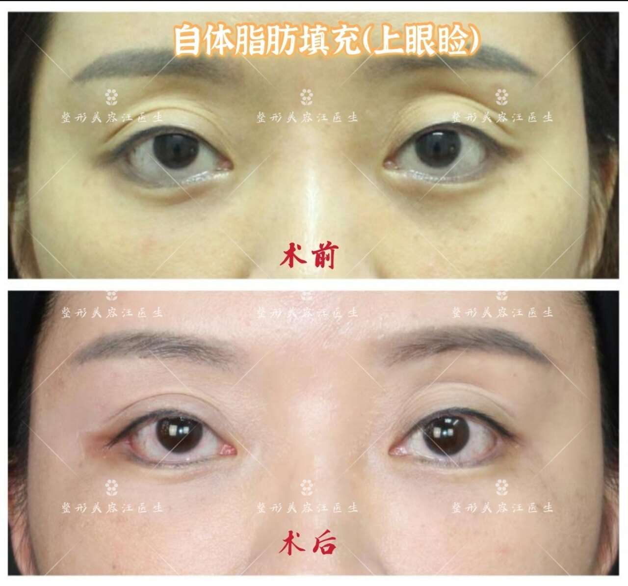 自体脂肪填充上眼睑凹陷