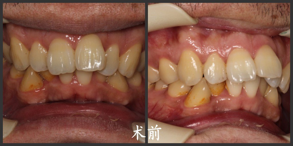 【矫正6个月】复诊装上下牙的牙套,上排牙齿变化明显排齐了一些,内收