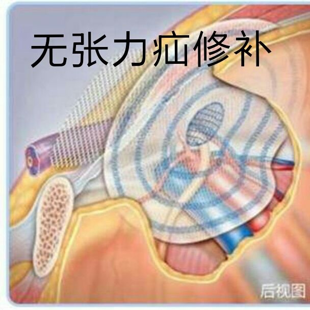 得了腹股沟疝如何合理选择手术方式