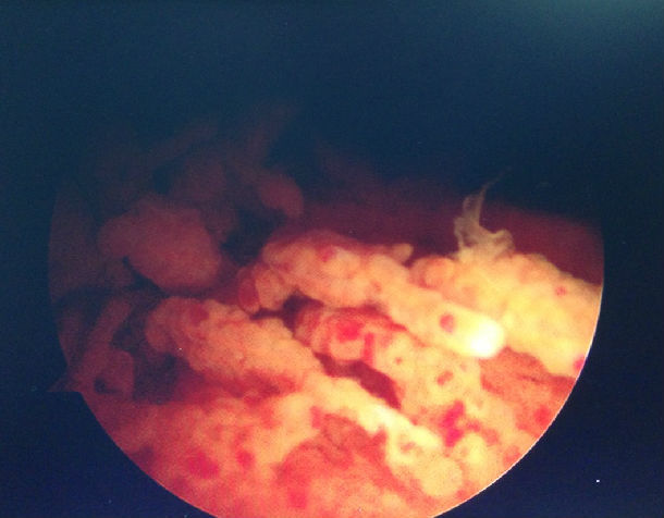 膝关节镜微创360度清理治疗色素沉着绒毛结节