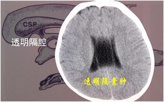 透明隔囊肿多数属于先天发育形成