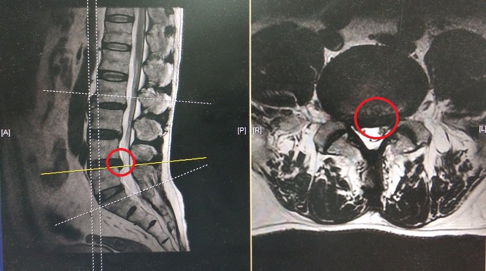 椎间孔镜治疗腰椎间盘突出症腰椎管狭窄症经典病例分享