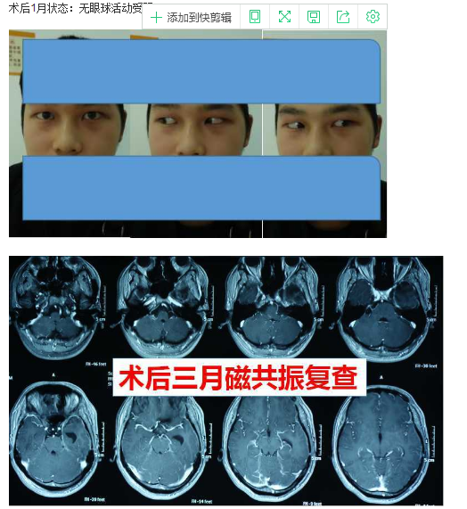 如何去看病三叉神经鞘瘤微创