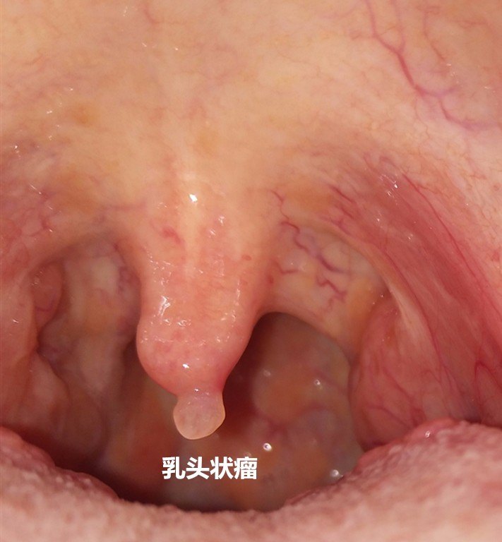 咽部乳头状瘤