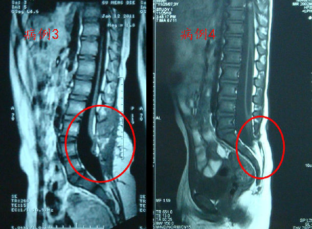 脊髓拴系综合征的患者影像学表现