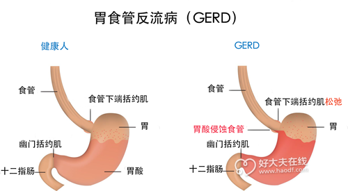 胃食管反流病的危害