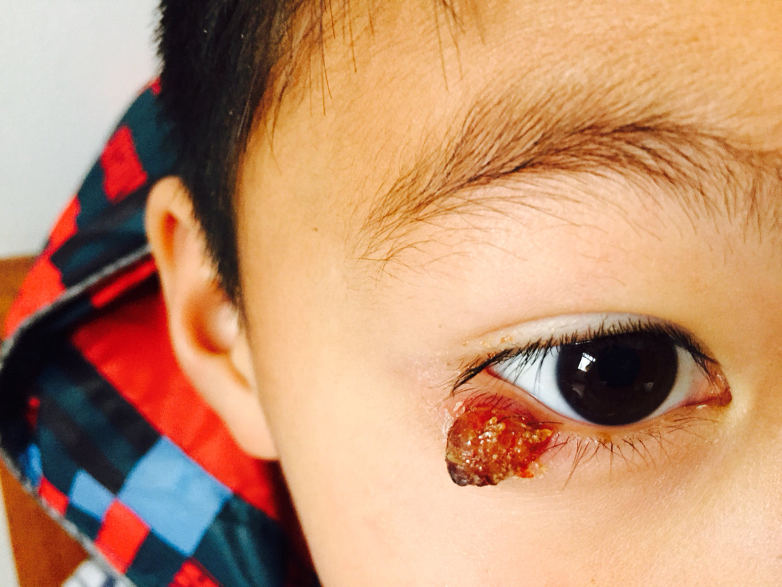 儿童眼睑麦粒肿早治疗