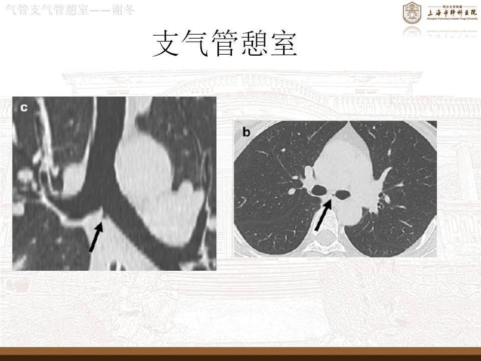 气管,支气管憩室