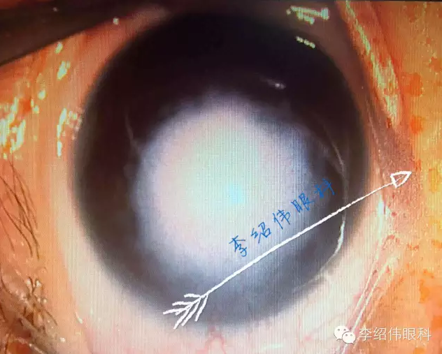 家长十分高兴 1,关于诊断:角膜皮样瘤为良性肿瘤,一般位于