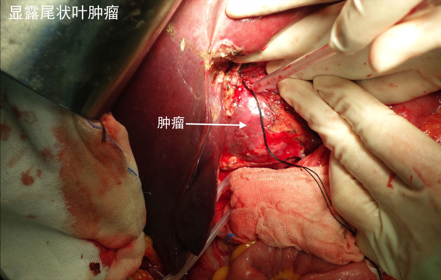 巨大尾状叶肝细胞肝癌切除术1例