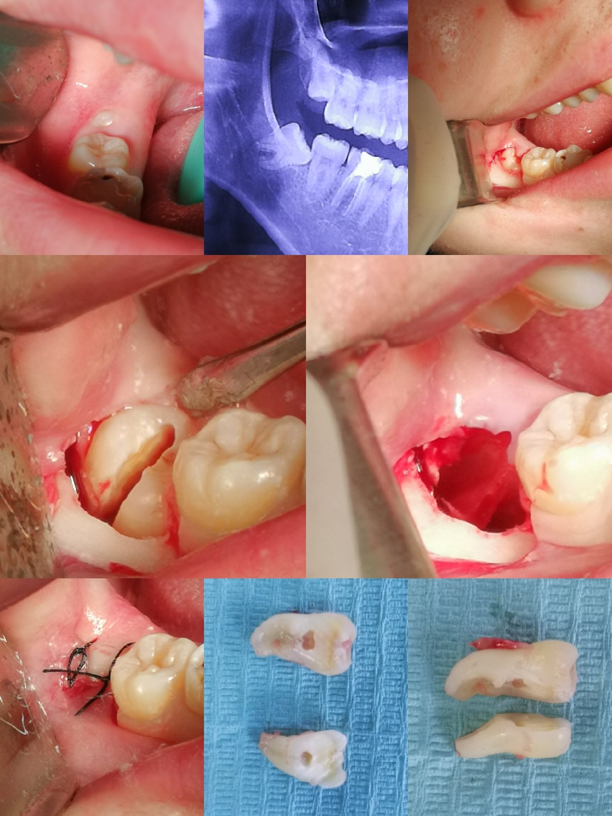 局部麻醉～切开翻瓣～涡轮机切割牙体～拔除智齿～清理缝合.