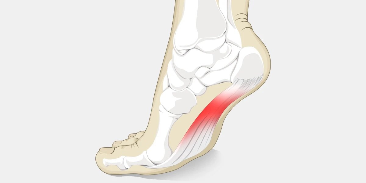 足底筋膜炎是指连接脚后跟和脚趾之间的纤维组织带的炎症.