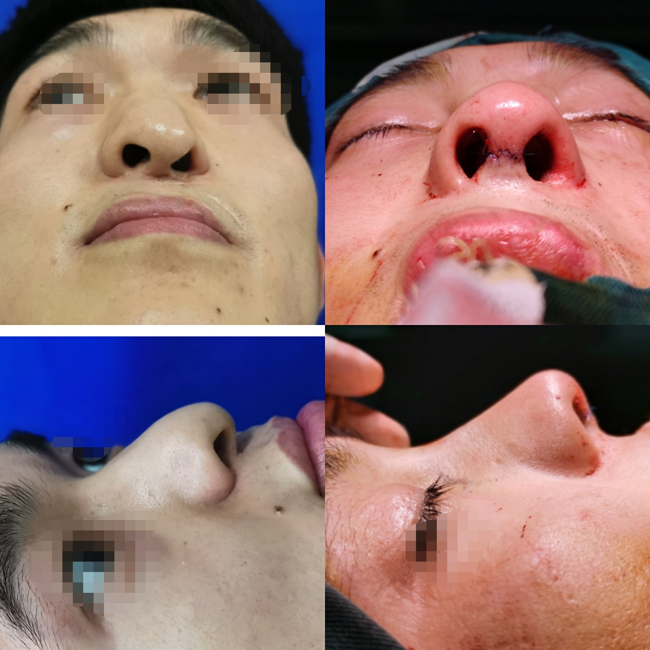 唇腭裂鼻畸形修复