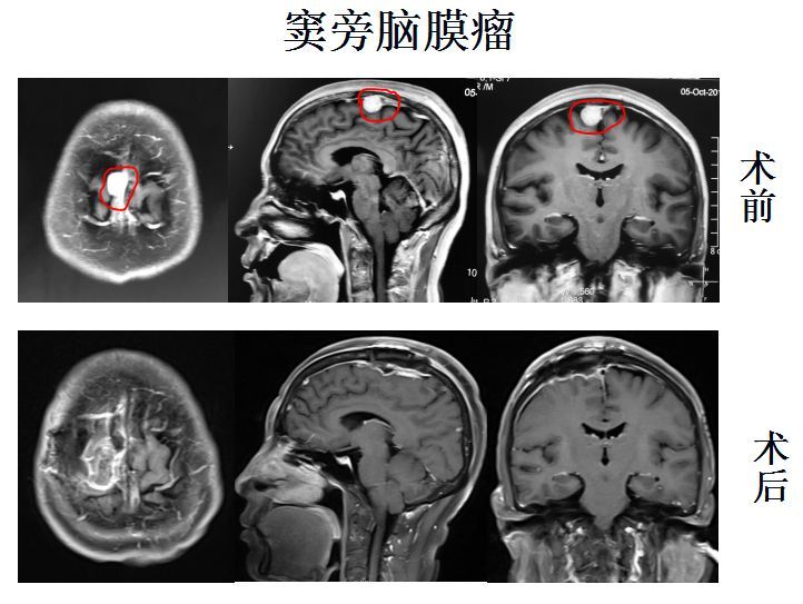 窦旁脑膜瘤