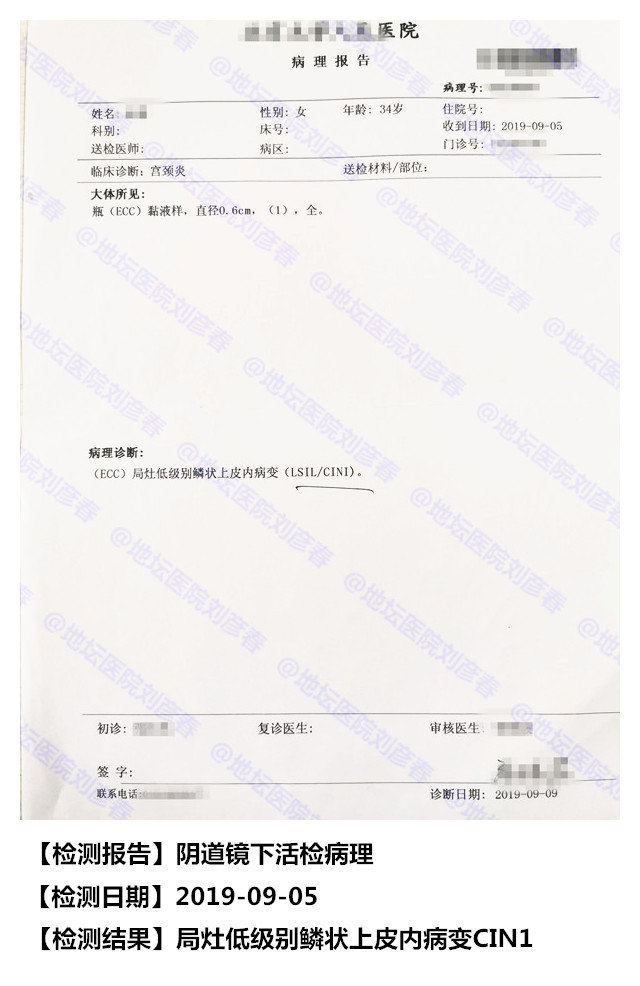 12,9月病理诊断为(ecc)局灶低级别鳞状上皮内病变(lsil/cin1).