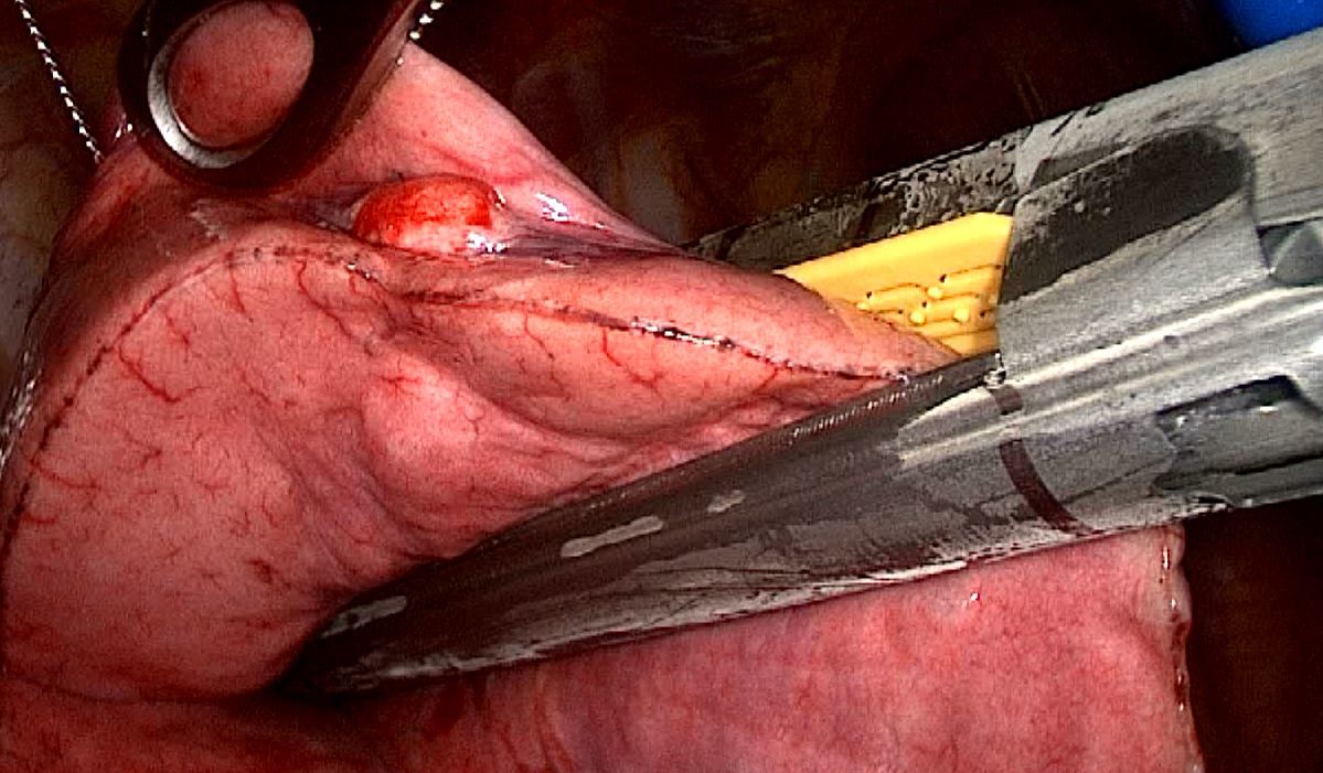 胸腔镜肺结节手术中的用的闭合钉是什么样的?需要取出来吗?