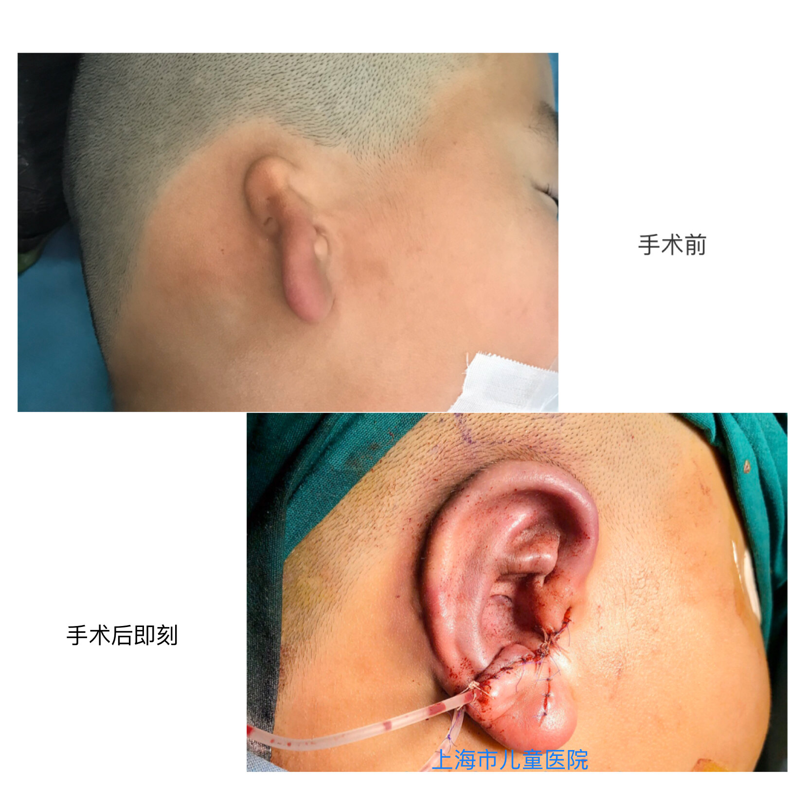 小耳畸形的手术治疗