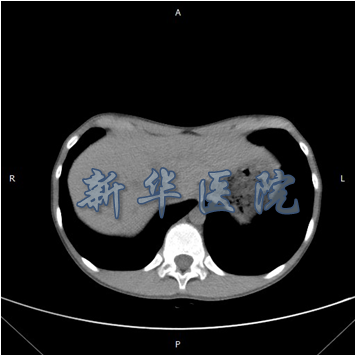 什么是漏斗胸漏斗胸长什么样如何诊断漏斗胸