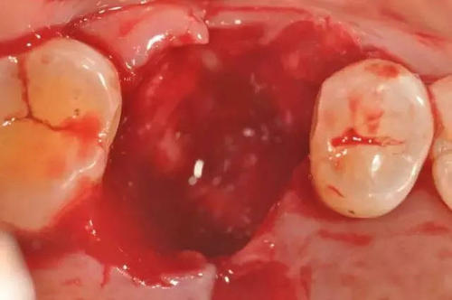 感染,主要发生在下颌阻生智齿即牙槽骨最里面的第三颗磨牙,一般在拔牙