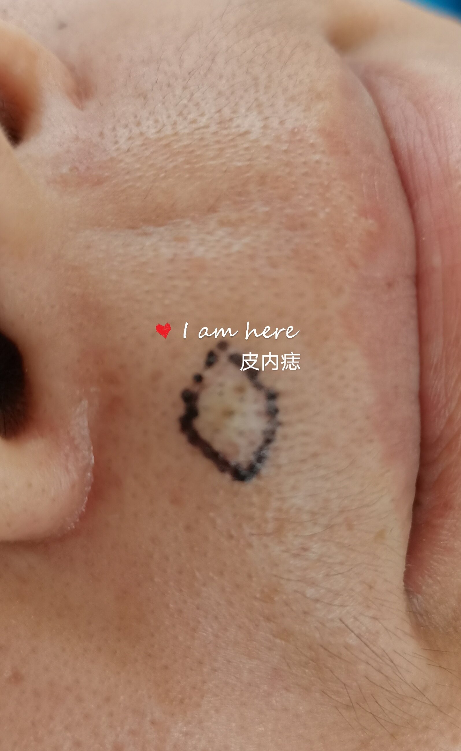 后天性色素痣分为先天性色素痣和后天性色素痣.
