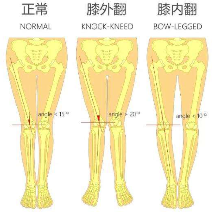 膝关节骨关节炎的阶梯治疗