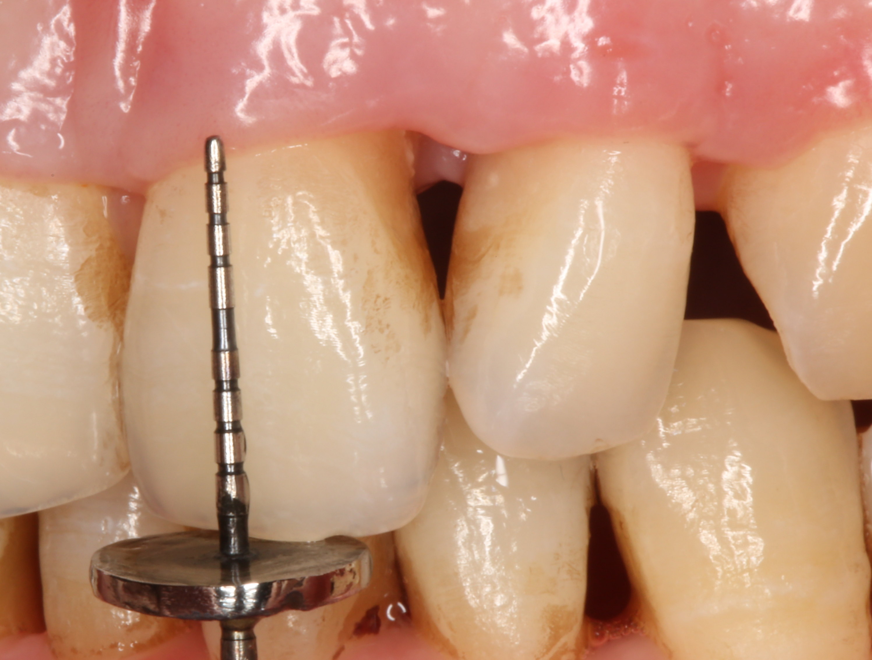 牙龈退缩注射治疗疗效如何