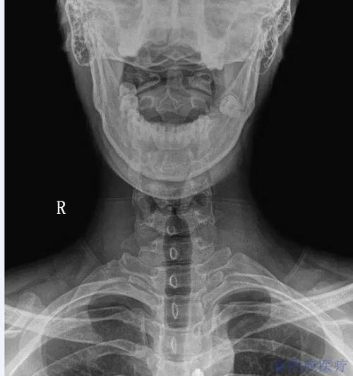正侧位片了解颈椎曲度和椎体错位情况 张口位片 可以了解第1.