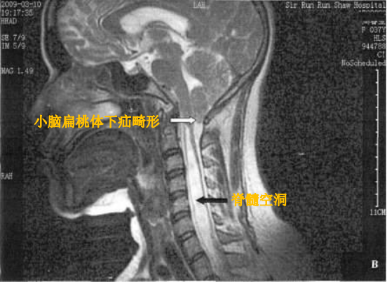 图( ):小脑扁桃体下疝合并 脊髓空洞 mri