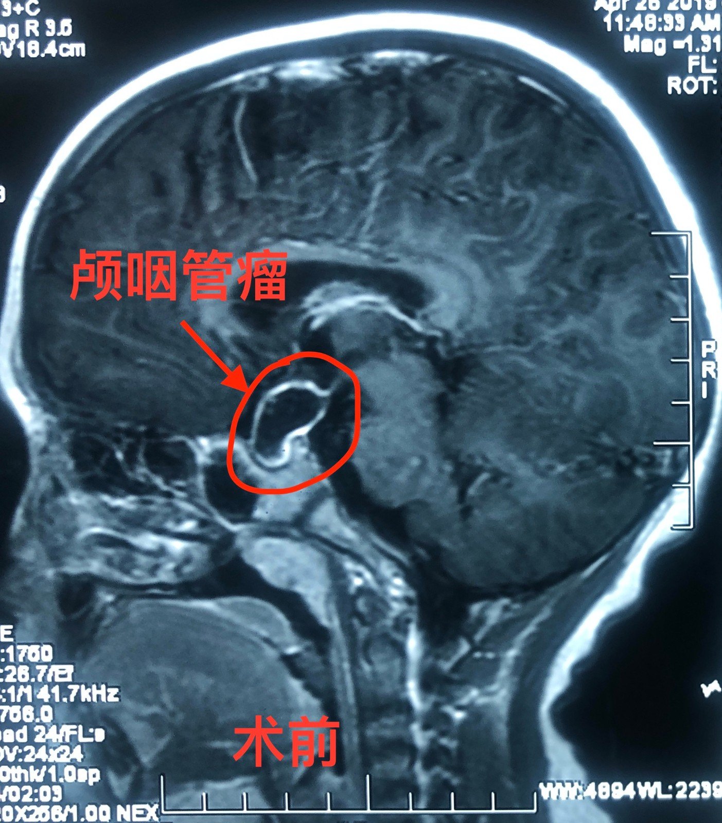 颅咽管瘤的手术治疗是一个大工程围手术的处理手术入路的选择术后处理