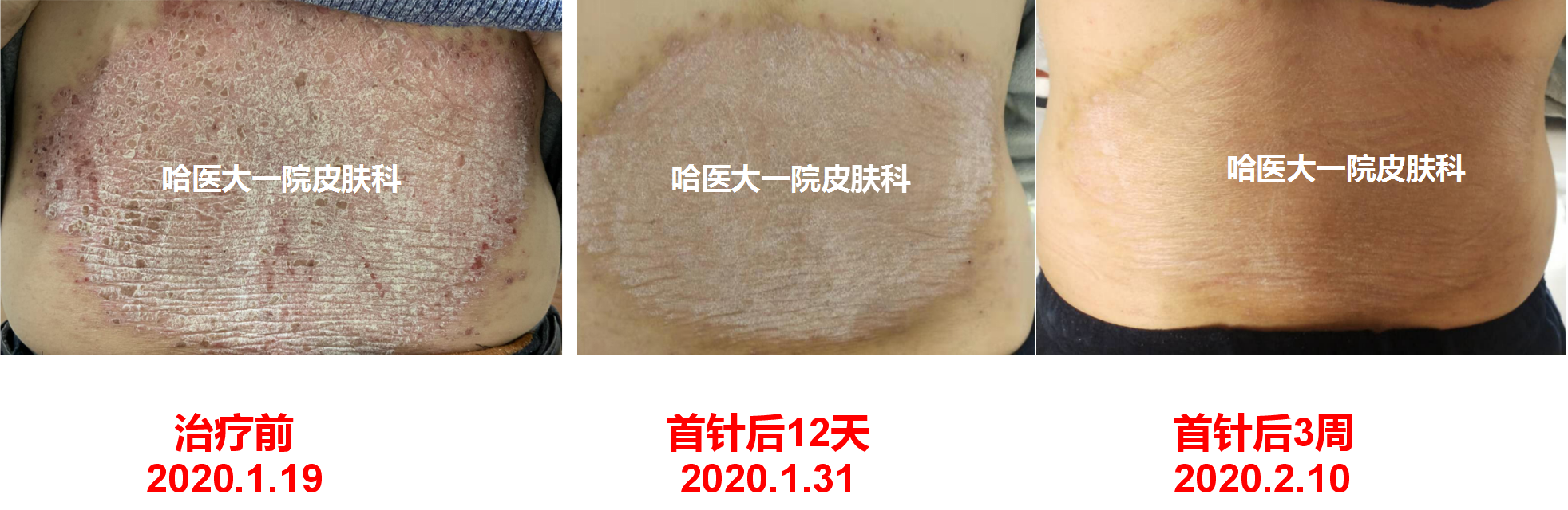 生物制剂是银屑病治疗的新选择