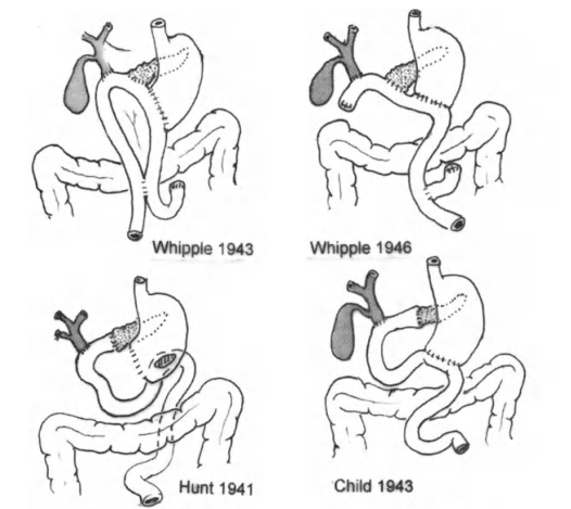 代军涛 文章列表 艾伦*惠普尔(allen whipple,1881~1963),胰腺外科
